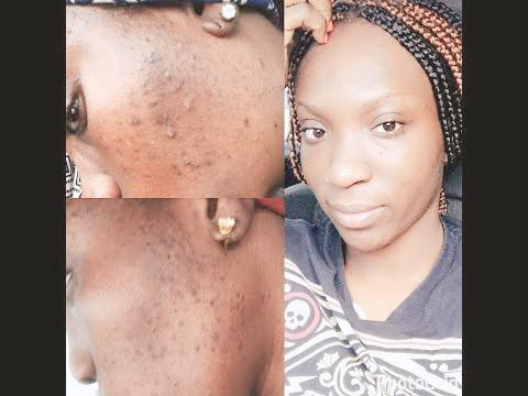 Skin Disorders in Krugersdorp - Image 6
