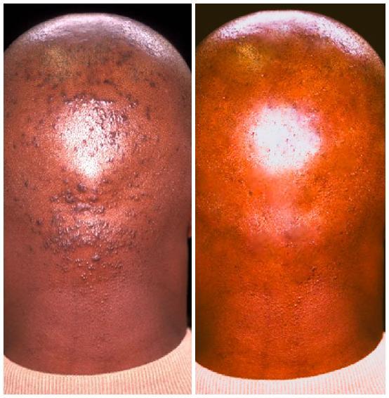 Skin Disorders in Vanderbijlpark - Image 4