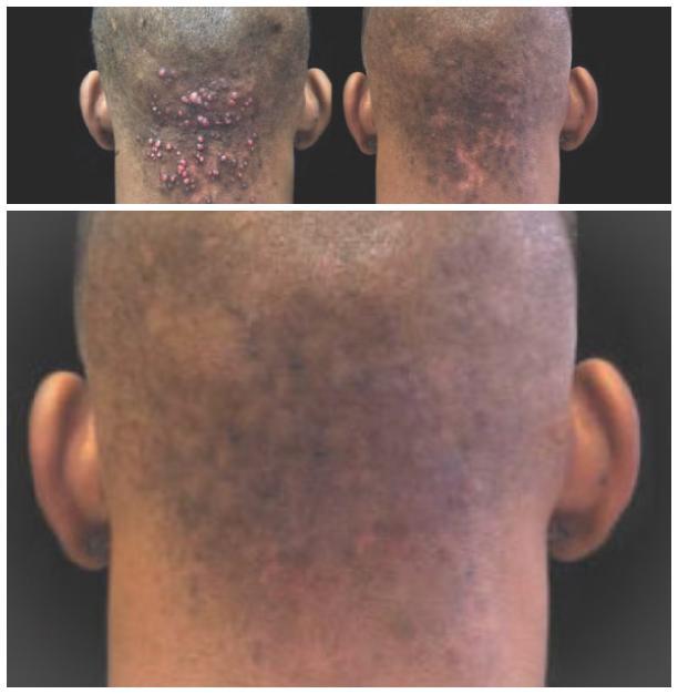 Skin Disorders in Vanderbijlpark - Image 6