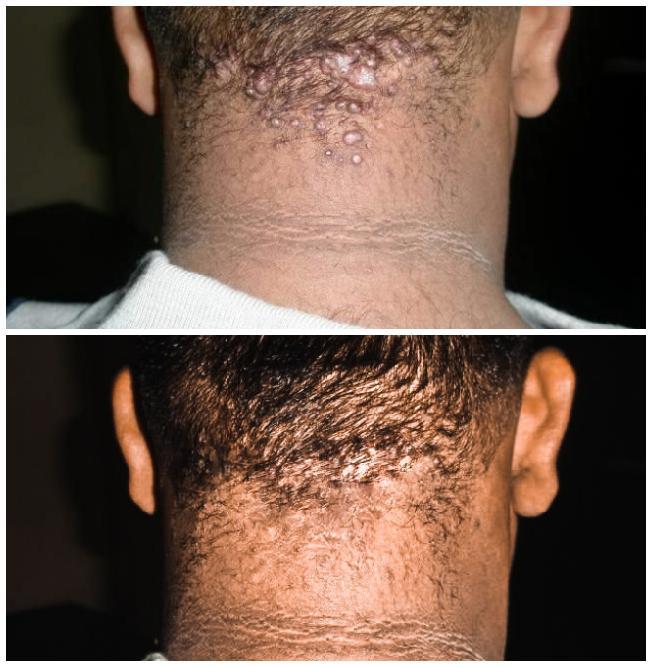 Skin Disorders in Krugersdorp - Image 2