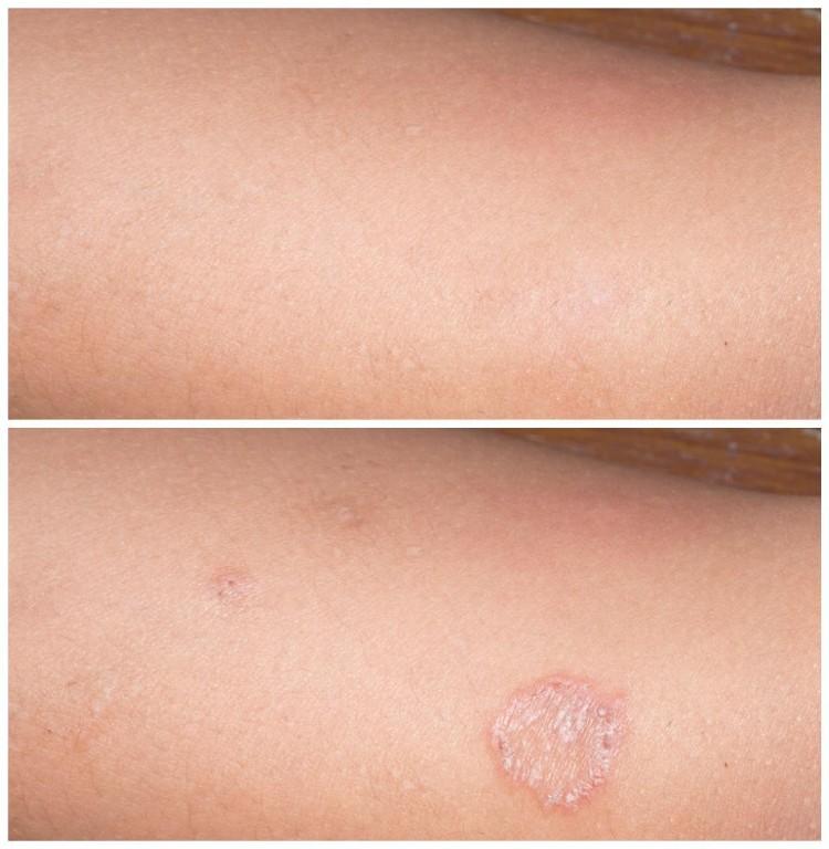 Skin Disorders in Roodepoort - Image 8
