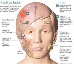 PARALISIS FACIAL-TRATAMIENTO en San Miguel de Pallaques - Imagen 1