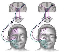PARALISIS FACIAL-TRATAMIENTO en San Miguel de Pallaques - Imagen 3