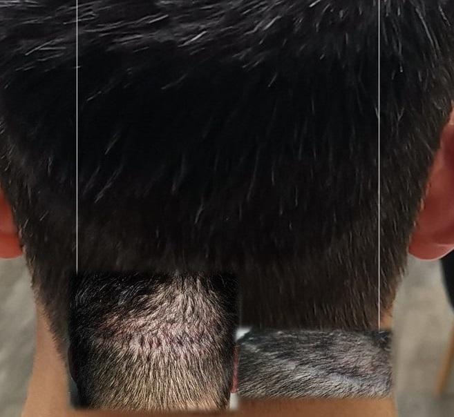 Scalp Micropigmentation For Scars (FUT & FUE) in Renfrew - Image 1