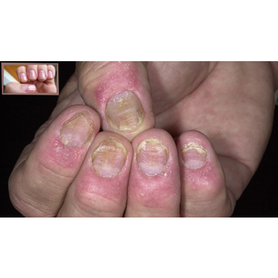 NO MAS PSORIASIS, ROSACEA AND EXZEMA. GARANTIZADO! en Miami - Imagen 7