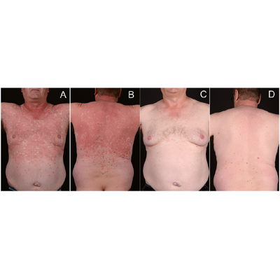 NO MAS PSORIASIS, ROSACEA AND EXZEMA. GARANTIZADO! en Miami - Imagen 8