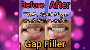 FIX your Tooth GAPS R450 in Durban - Image 1