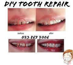 FIX your Tooth GAPS R450 in Durban - Image 2