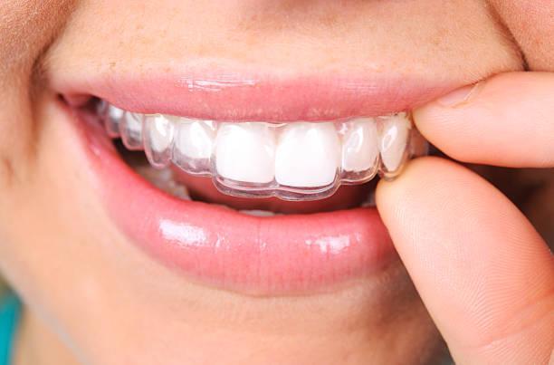 Understanding Invisalign Treatment in Nārsingi - Image 1