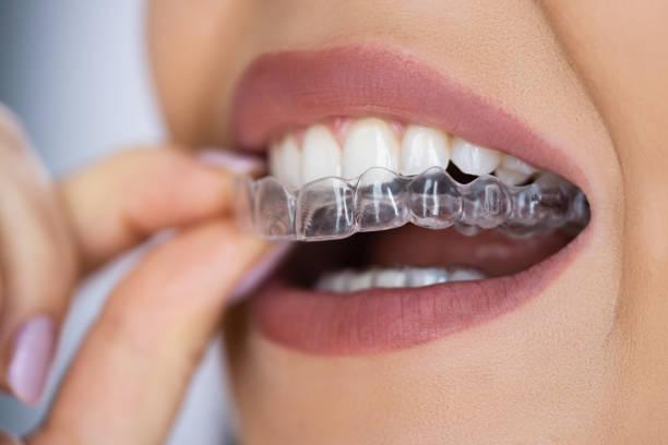 How Invisible Aligners Work in Mumbai - Image 1