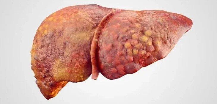 Ayurvedic Cure for Liver Cirrhosis in Rishikesh – Panchakarma & in Rishīkesh - Image 1