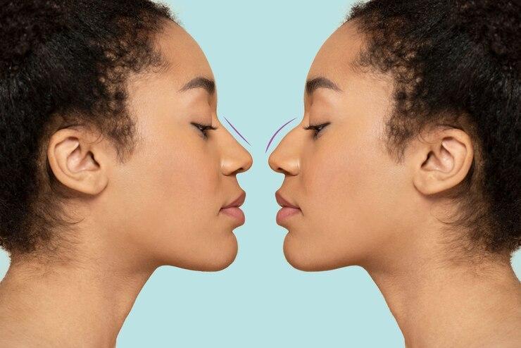 Rhinoplasty Cost In Pune | Nose Surgery In Pune in Pune - Image 3