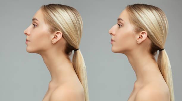 Rhinoplasty surgery in Riyadh in Taliparamba - Image 2