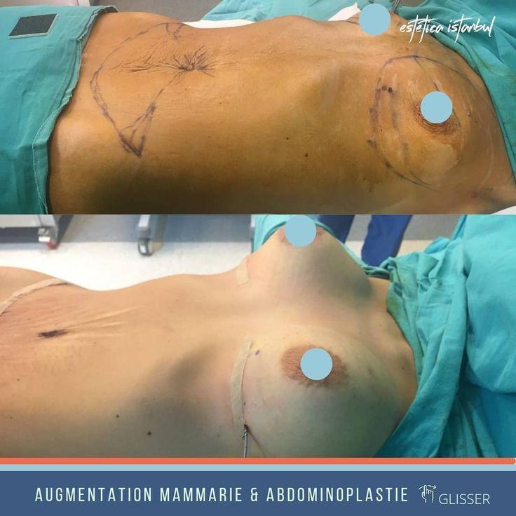 Augmentation mammaire au Cameroun - Photo 2
