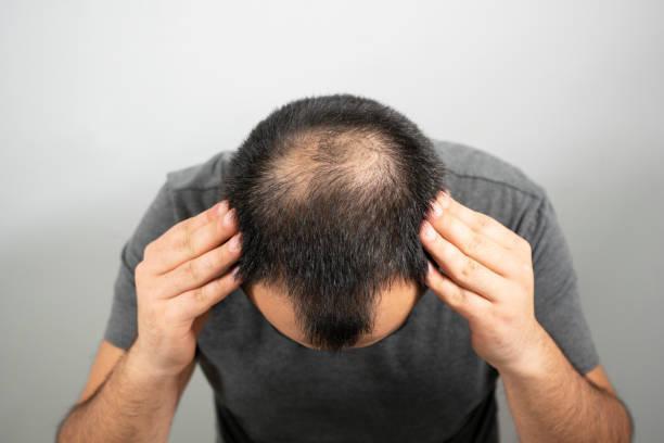 Hair Transplantation in Riyadh in Taliparamba - Image 1