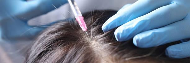 Hair Transplantation in Riyadh in Taliparamba - Image 2