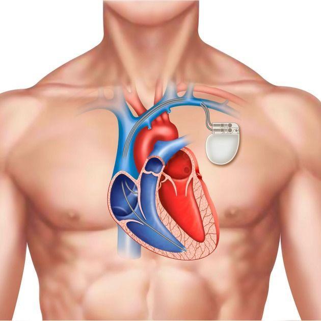 Implantation d’un Pacemaker au Cameroun - Photo 3
