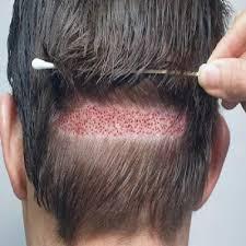 Hair Transplant in Riyadh in India - Image 1