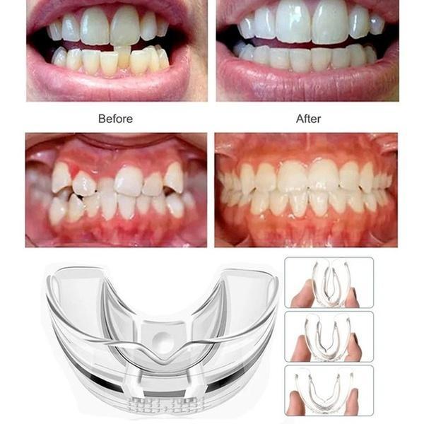 Teeth Braces R1000 in Durban - Image 4
