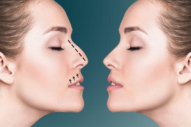 Rhinoplasty in Riyadh in India - Image 1