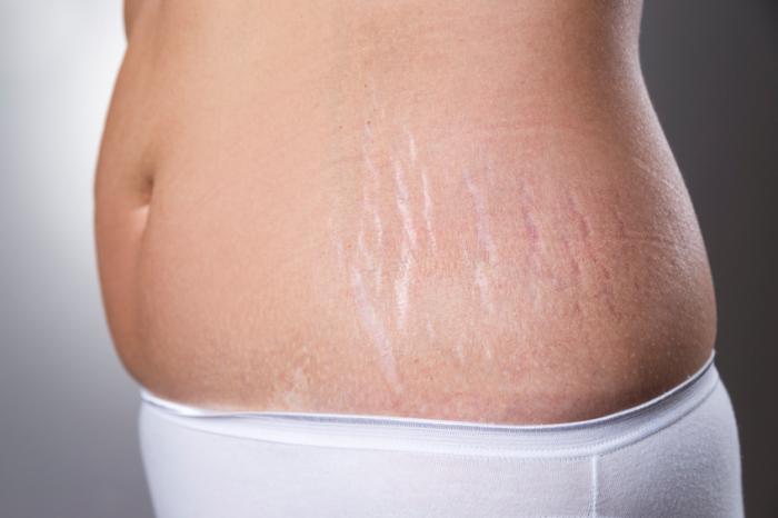 How Can You Reduce Stretch Marks – Advanced Solutions for Smooth in India - Image 1