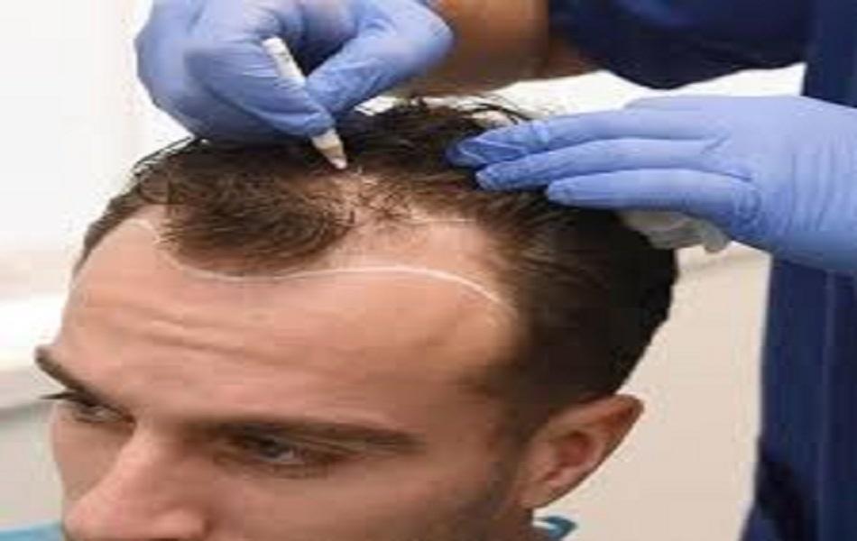 Hair Transplant in Riyadh in India - Image 1