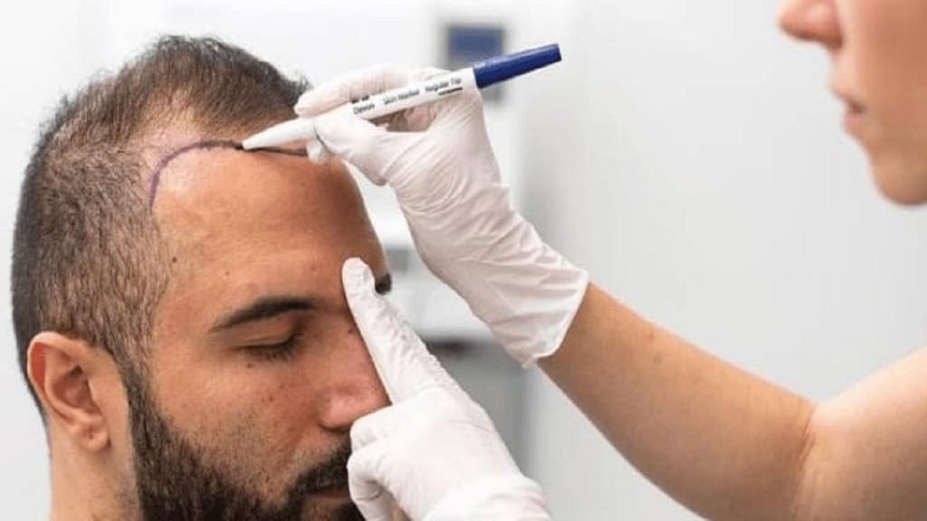 Hair Transplant in Riyadh in India - Image 2