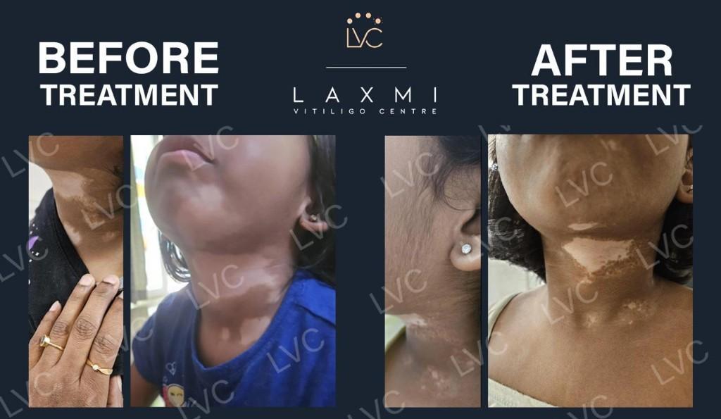 Effective Vitiligo & Leucoderma Cure in Tallākulam - Image 1