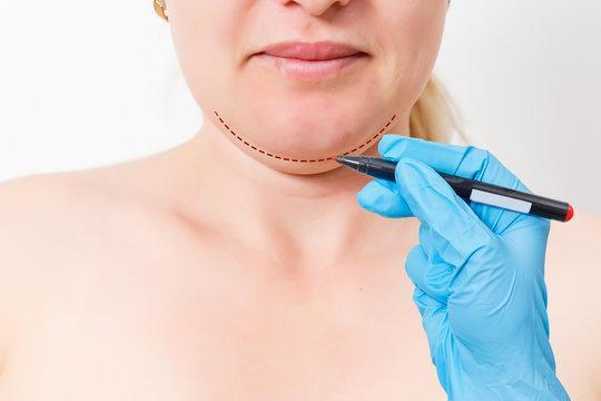 Chin Reduction Surgery in Riyadh in India - Image 1