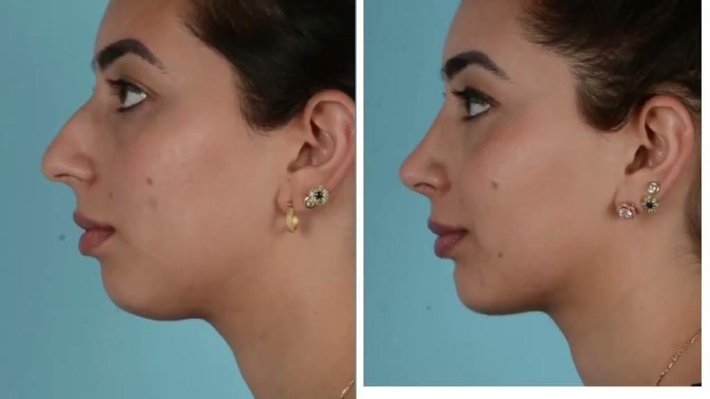 Chin Reduction Surgery in Riyadh in India - Image 2