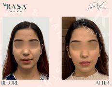 Aqualyx Fat Dissolving Injections Rasaderm in India - Image 1