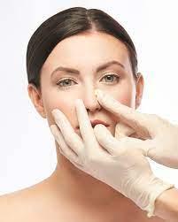 Rhinoplasty in Riyadh in Taliparamba - Image 1