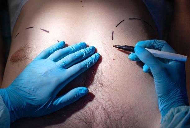Gynecomastia Surgery in Riyadh -- Saudi Arabia in Dwārka - Image 2
