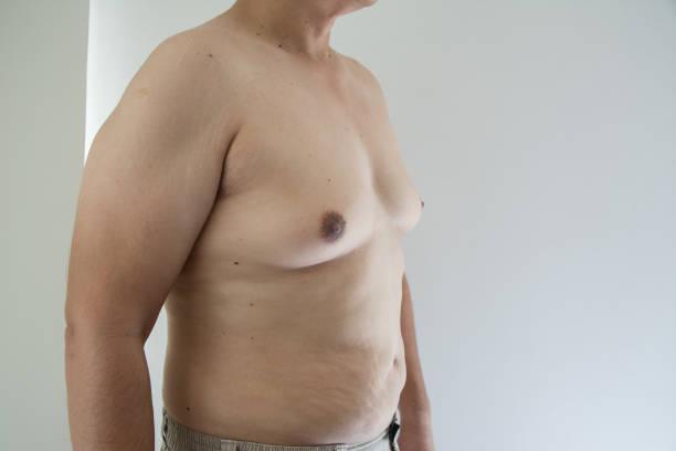 Gynecomastia Surgery in Riyadh 58 in Dwārka - Image 2