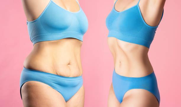 Liposuction Surgery in Taliparamba - Image 2