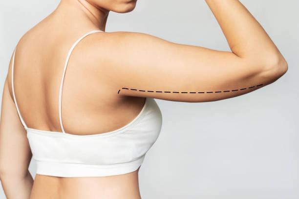 Liposuction surgery in Riyadh in Kannur - Image 1
