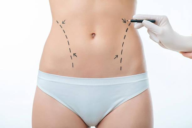 Liposuction surgery in Riyadh in Kannur - Image 2