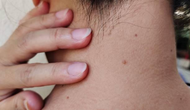 Skin Tag Removal in Riyadh in India - Image 1