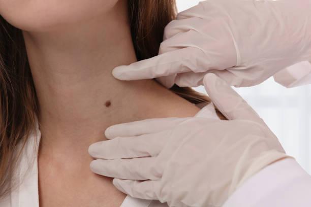 Skin Tag Removal in Riyadh in India - Image 3