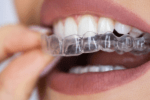 How do traditional braces work in BTM 16th Main - Image 1