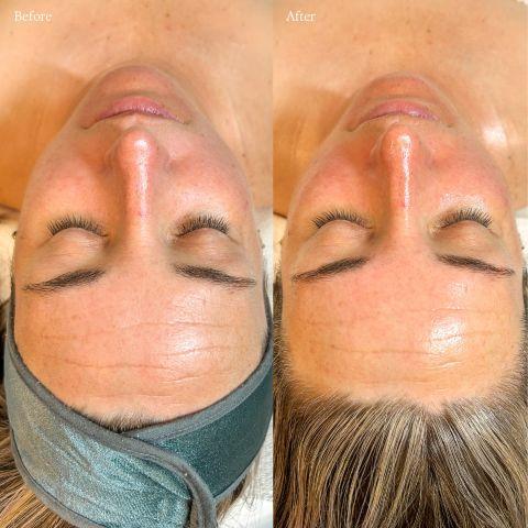 LED Light Therapy Treatment in Canada - Image 2