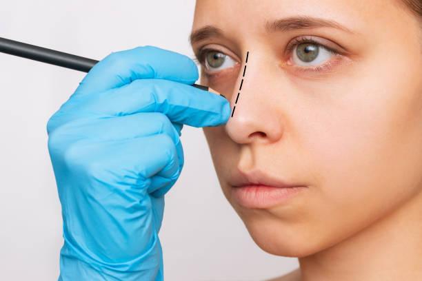 RHINOPLASTY SURGERY in Trimulgherry - Image 2