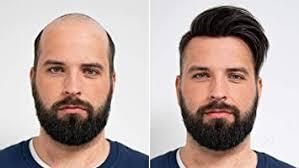 Hair replacement add. in Haldwāni - Image 2