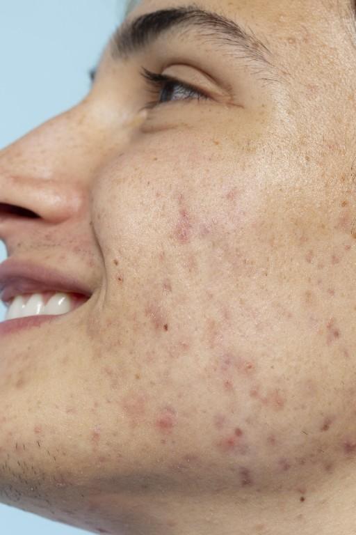 Dramatically Improve Skin Texture by Clearing Clogged Pores in India - Image 1