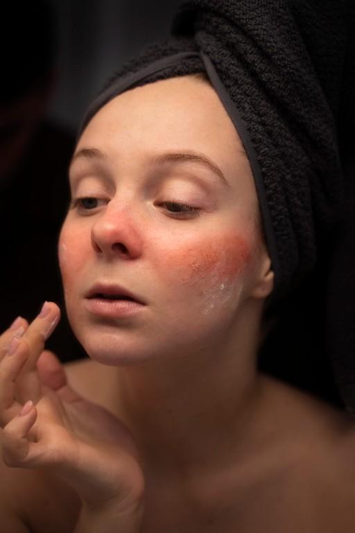 Stop Drying Out Pimples! Start Healing Intelligently in India - Image 1