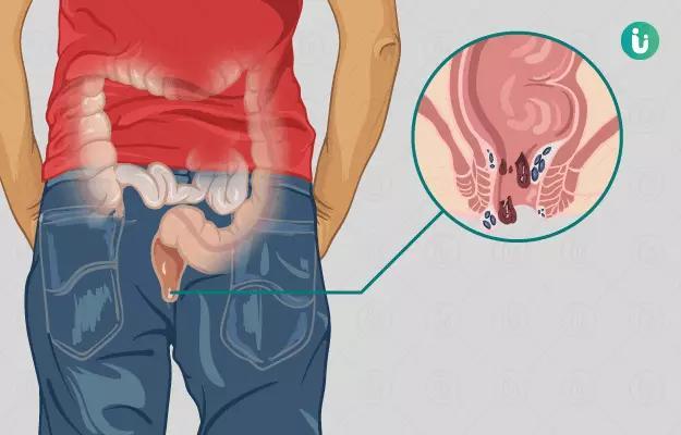 Best Doctors For Fissure Treatment In Meerut in Meerut - Image 2