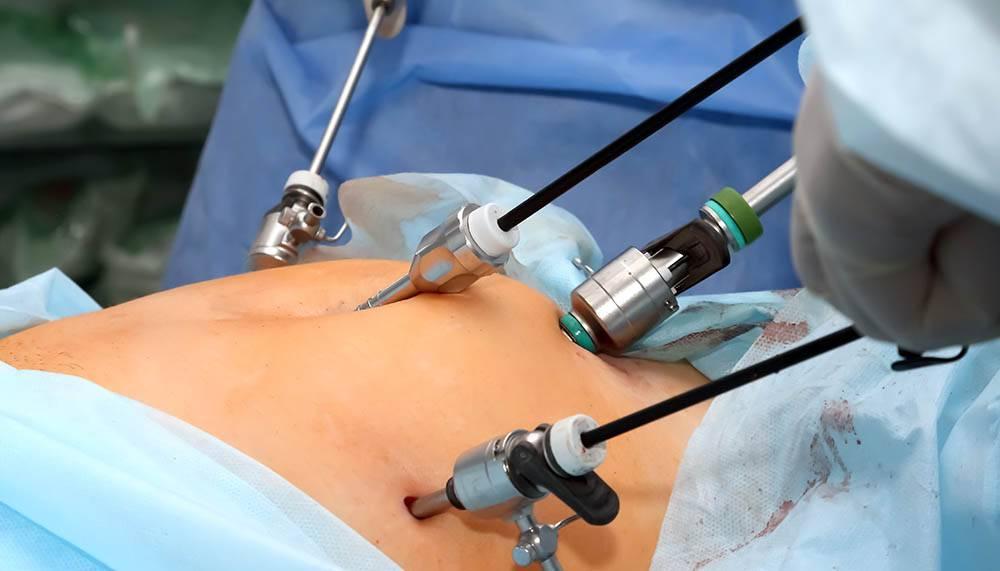 Advanced Laparoscopic Surgery in Varanasi in Varanasi - Image 1
