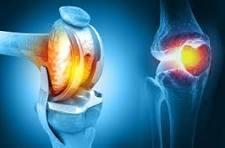 Knee replacement surgery in Kadiri - Image 2