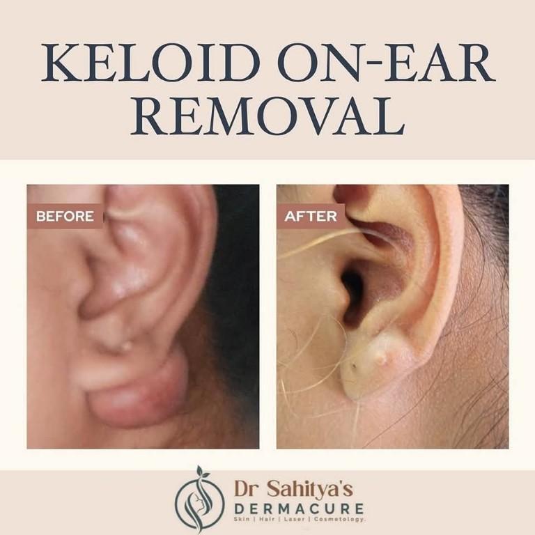 Keloid Treatment In Rajahmundry- in India - Image 1
