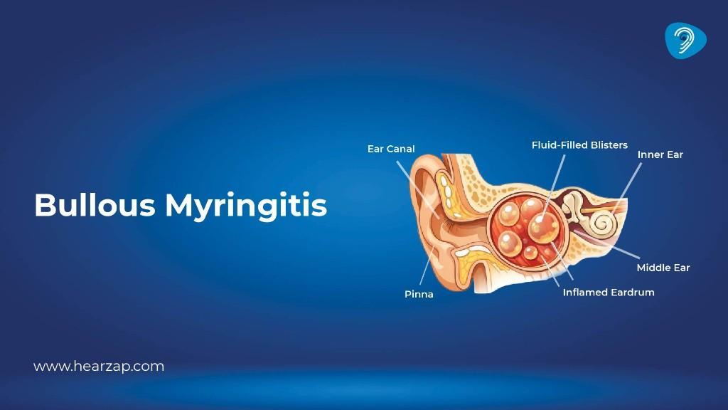 Myringotomy Procedure, Benefits, Recovery & Cost Guide in India - Image 1